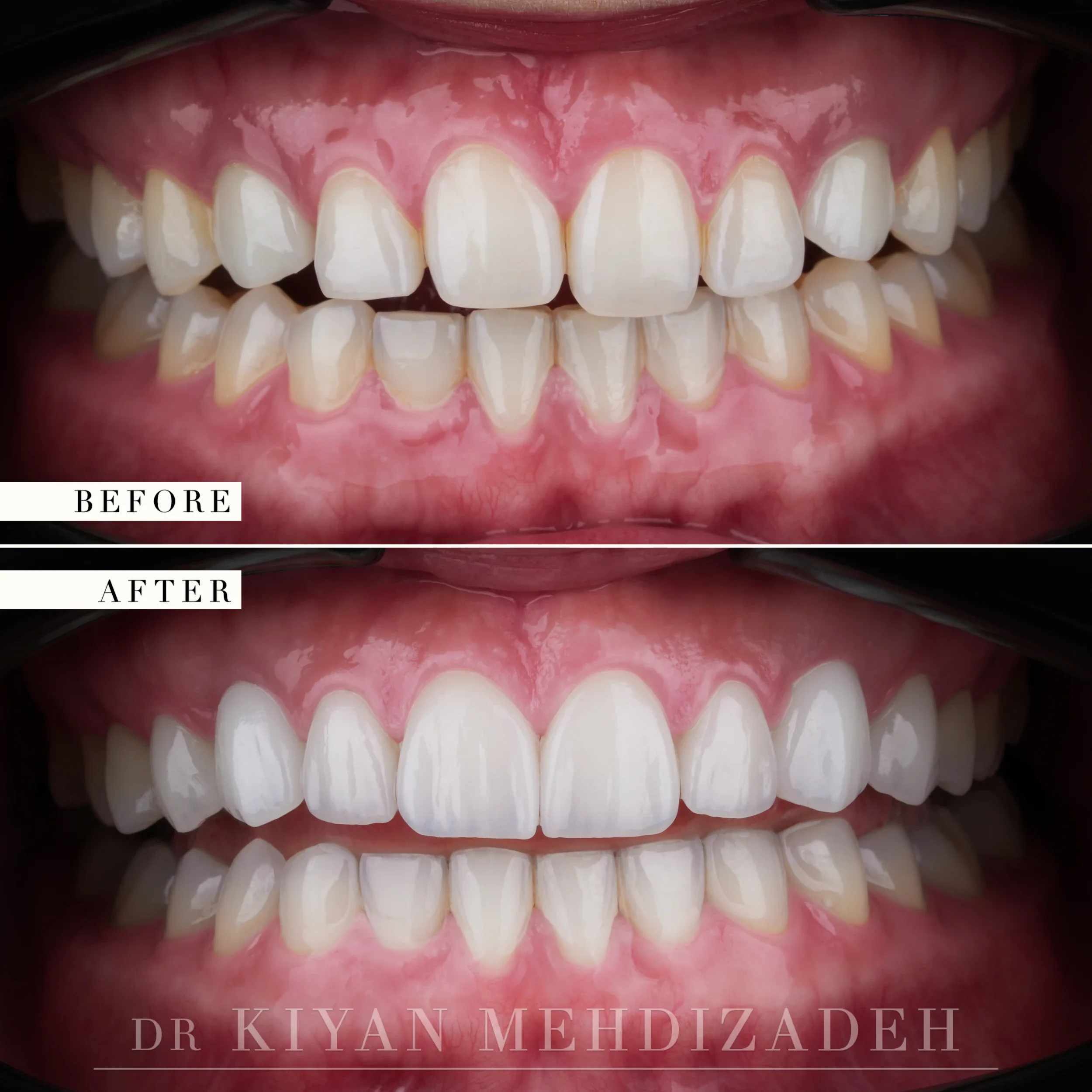 Before and after retracted view of the full arch showing porcelain veneer and implant crown detail