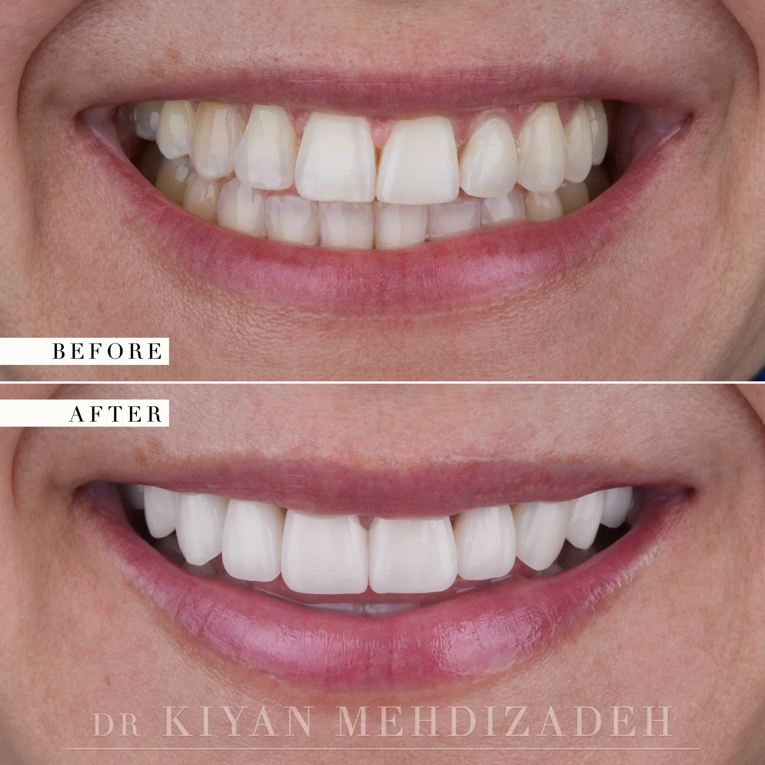 Before and after: an off-center midline with a dark space between the central incisors, corrected to a centered, even upper smile with ten porcelain veneers, Beverly Hills