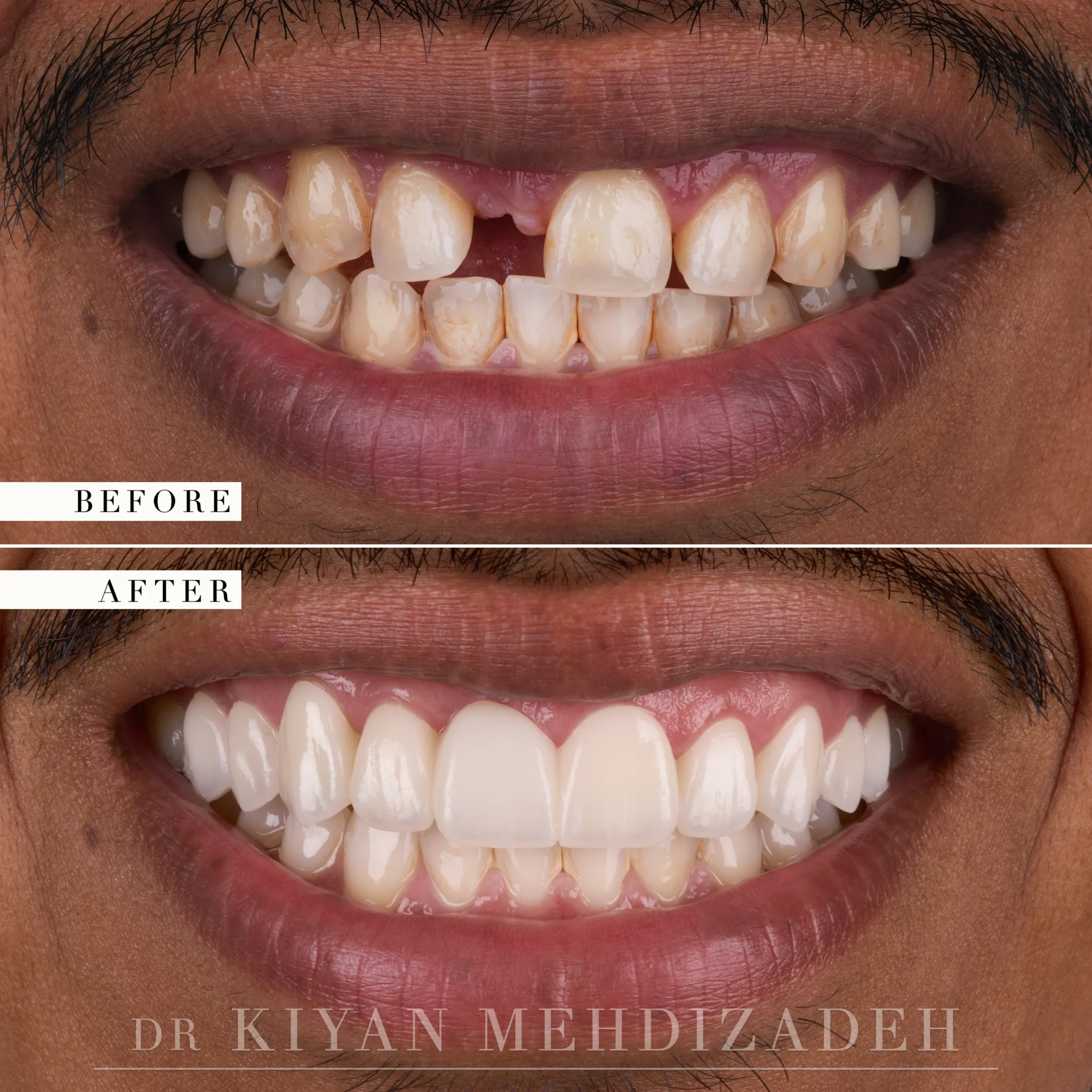 Missing front tooth replaced with a bridge and veneers, before and after, by Dr. Kiyan Mehdizadeh in Beverly Hills