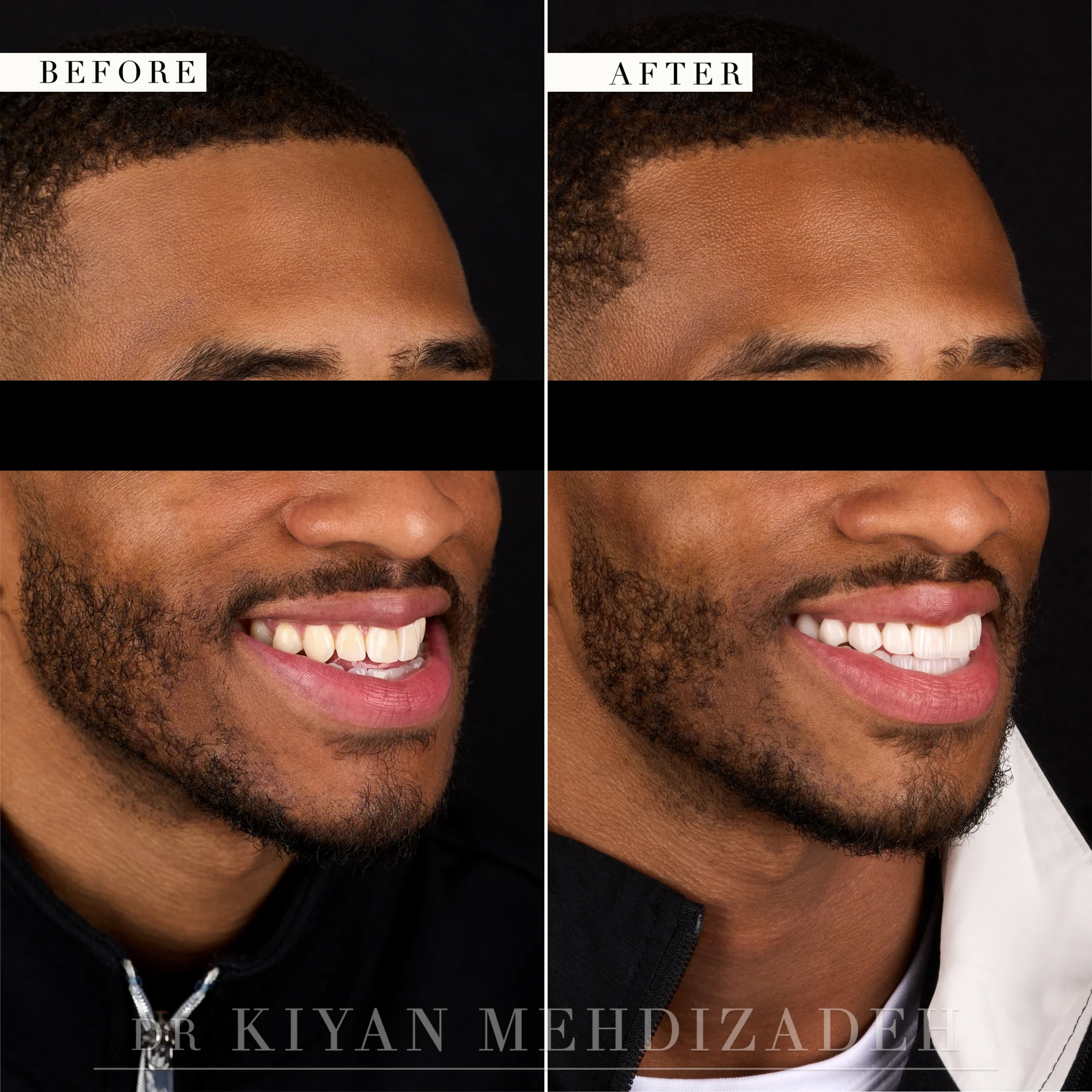 Three-quarter right view after underbite correction with veneers