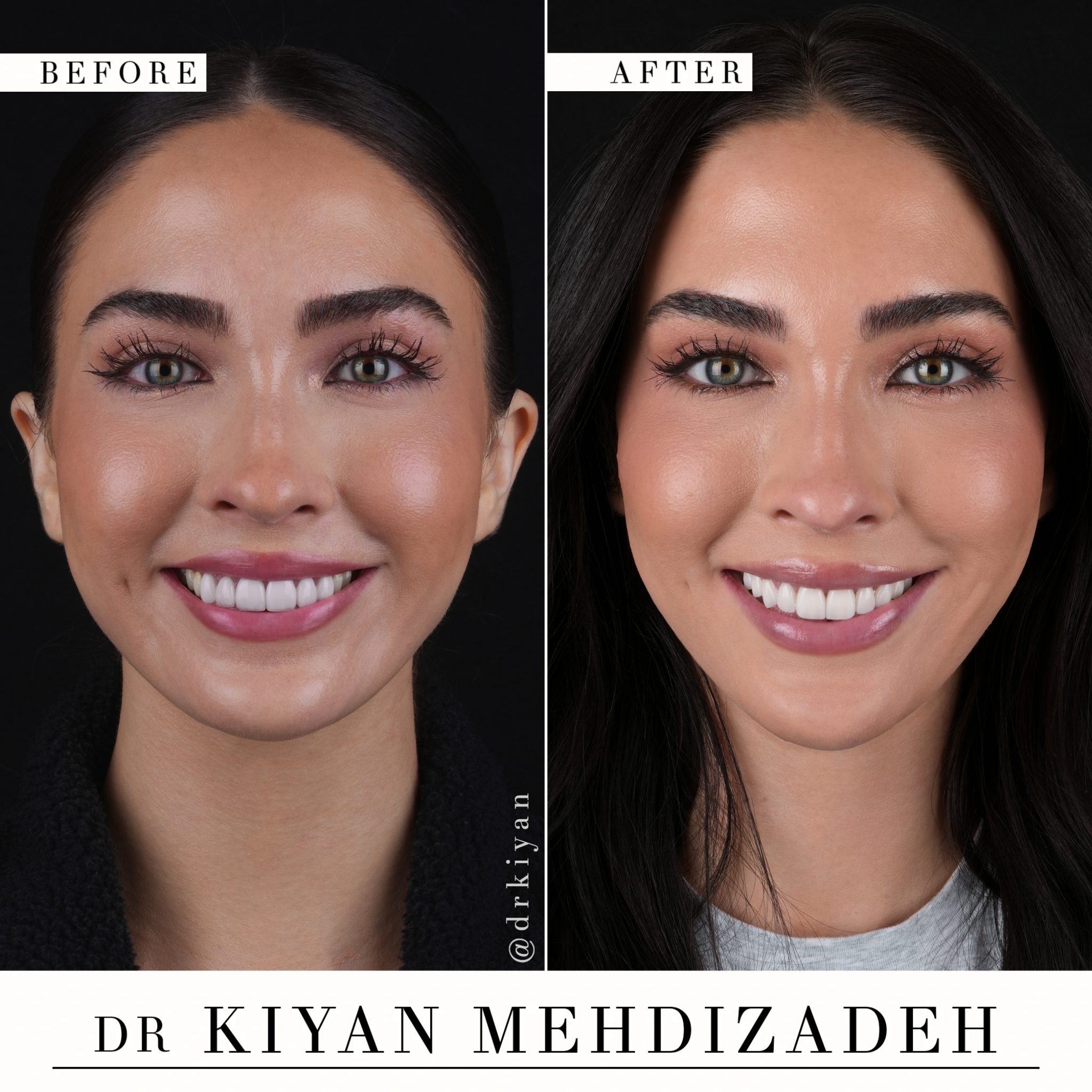 Full Face Before and After Veneer Replacement - Dr. Kiyan Mehdizadeh Beverly Hills