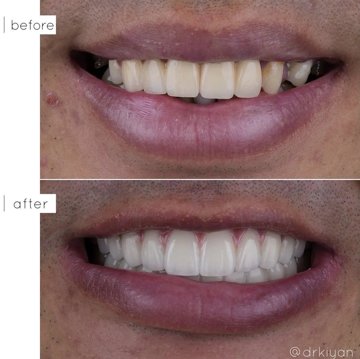 All-on-4 Implant-Supported Bridge Final Result - Dr. Kiyan Mehdizadeh