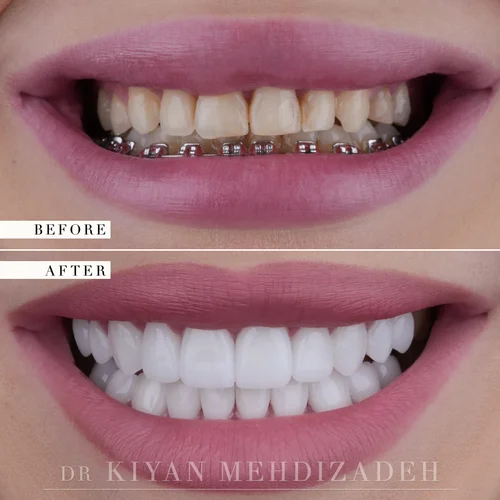 Smile makeover after braces before and after &mdash; Case Study 11