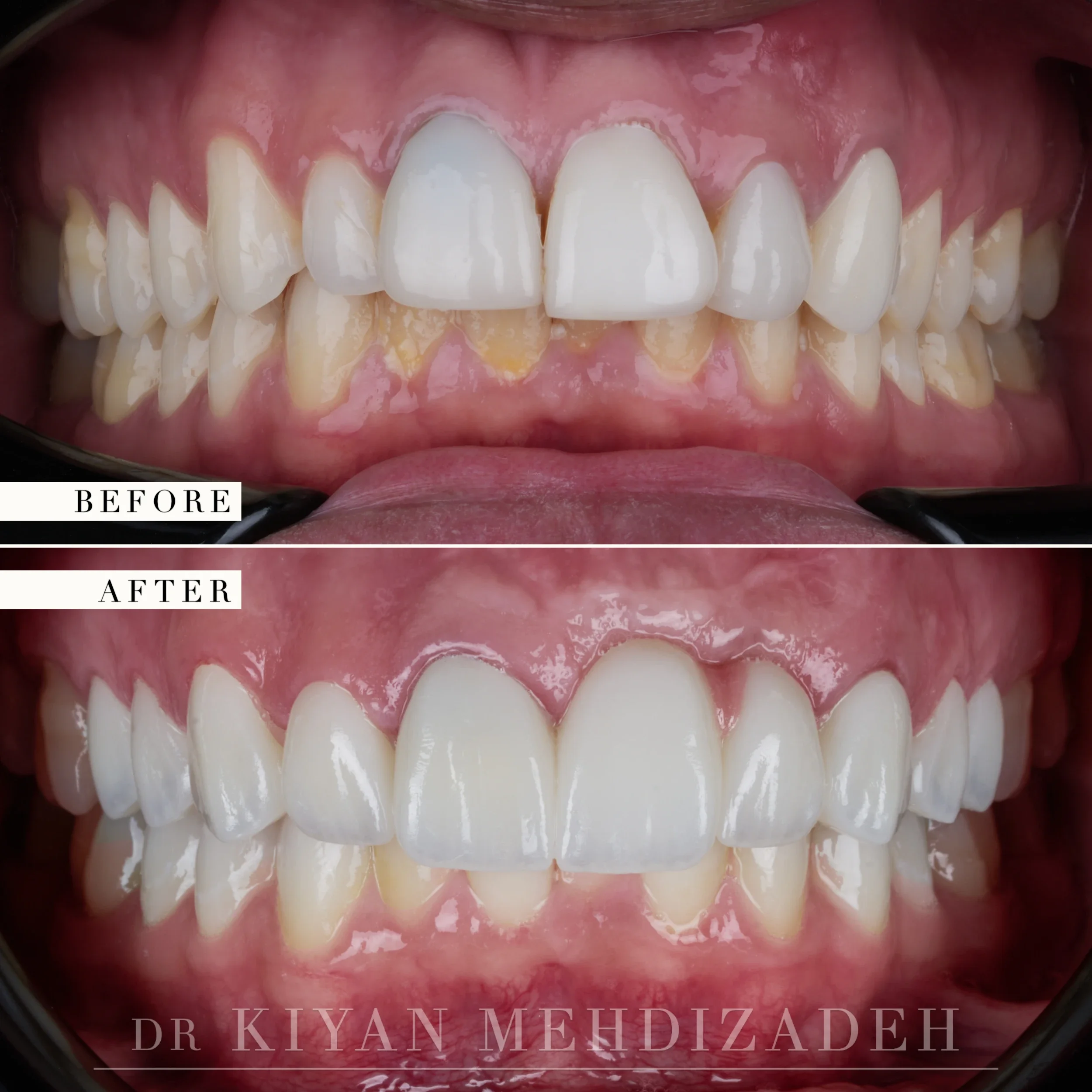 Retracted view showing the pink porcelain bridge and veneers