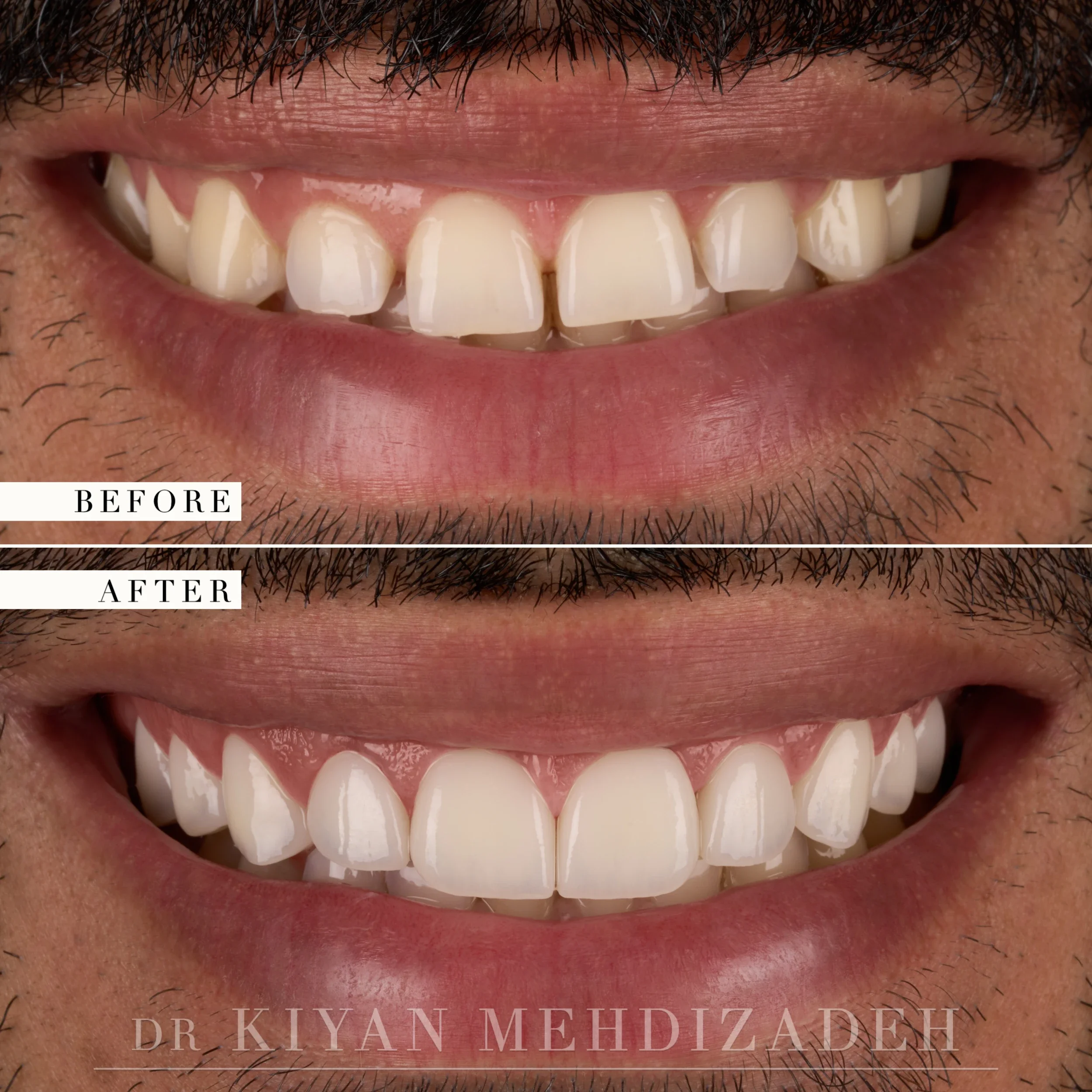 Gummy smile corrected with crown lengthening and veneers, before and after, Beverly Hills