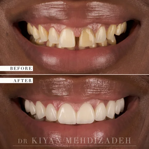 Gap Closure & Discoloration: Veneers before and after - Case Study 22 - Dr. Kiyan Mehdizadeh