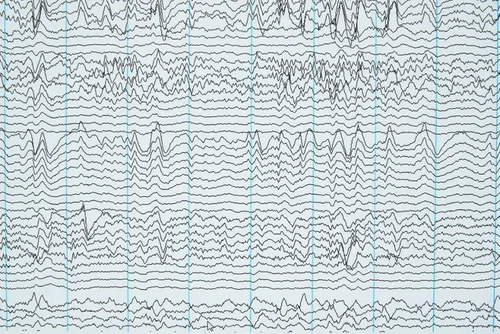 EEG brainwave activity recorded on a printed chart