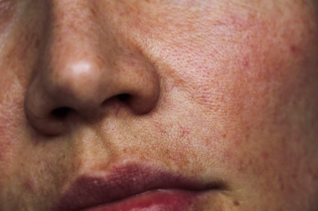 Pigmentation