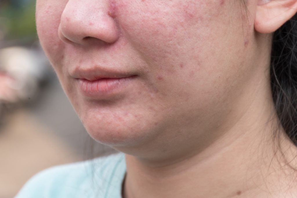 Pigmentation