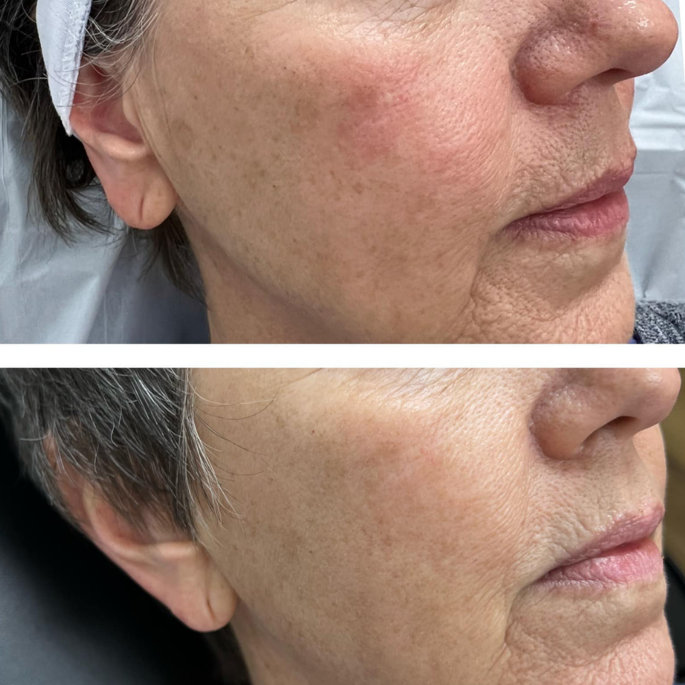 Microchanneling therapy results