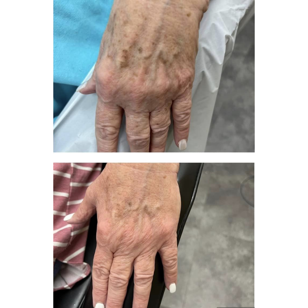 Skin therapy results by Kelly Frey