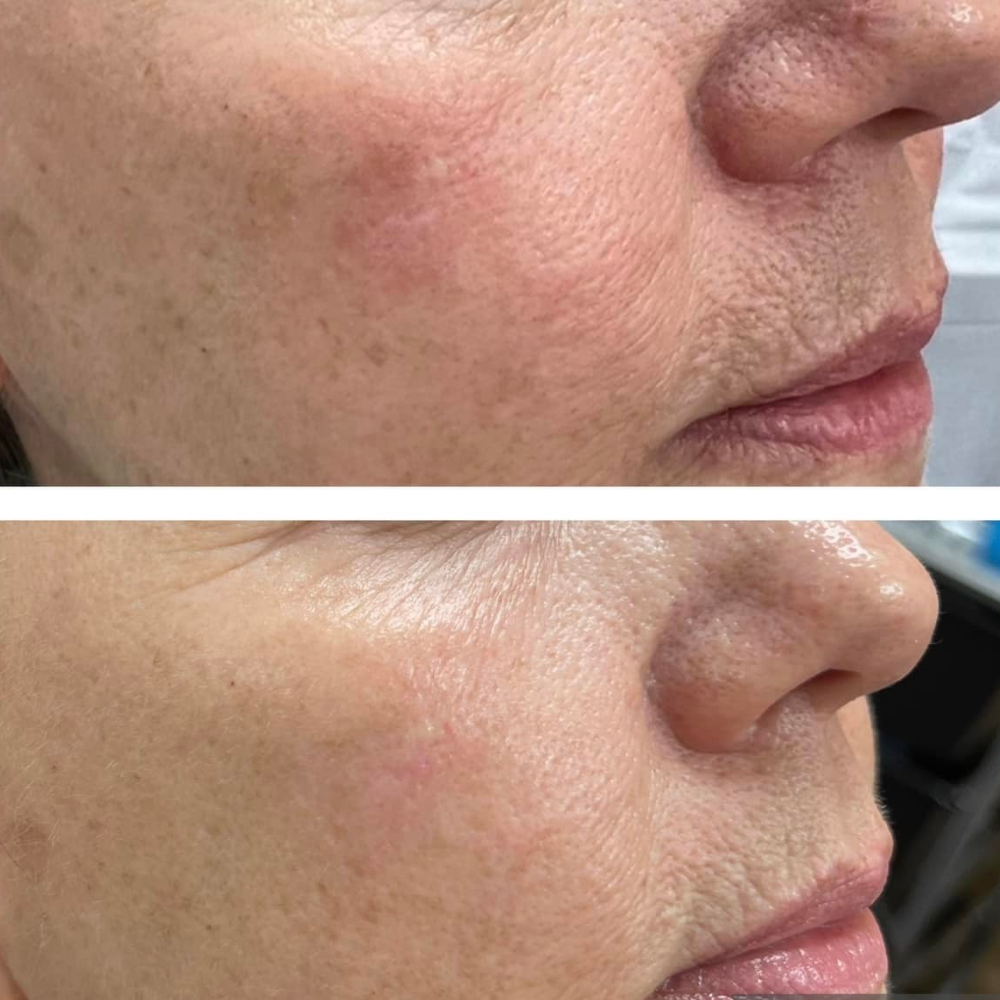 ProCell therapies before and after