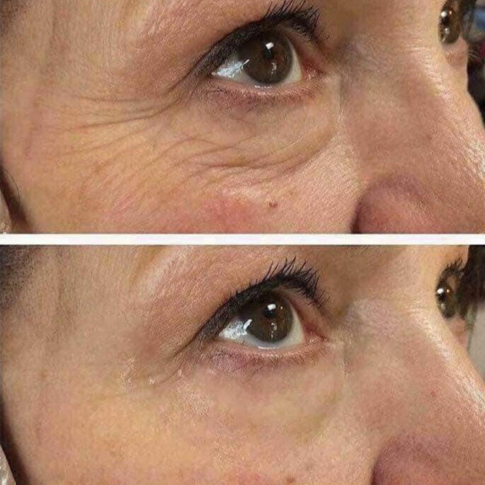 ProCell microchanneling results by Kelly Frey