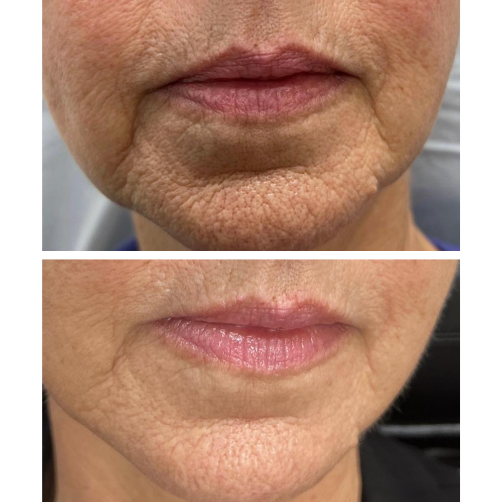 Mature skin therapy results by Kelly Frey