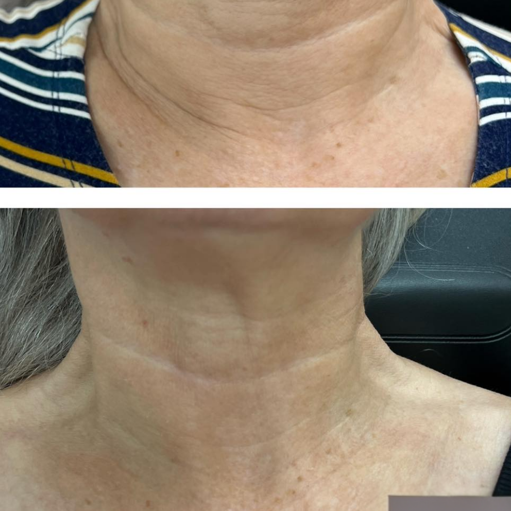 Microchannel therapy results