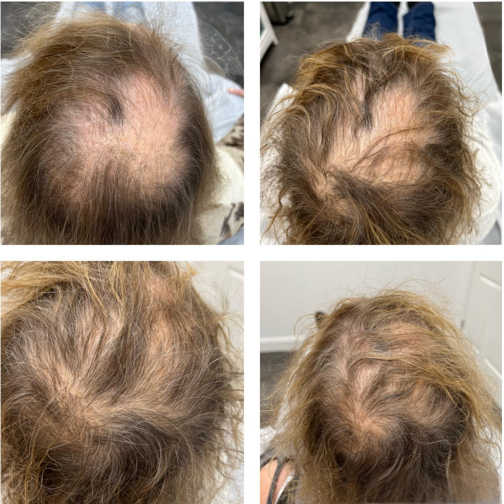 Hair rejuvenation results by Kelly Frey