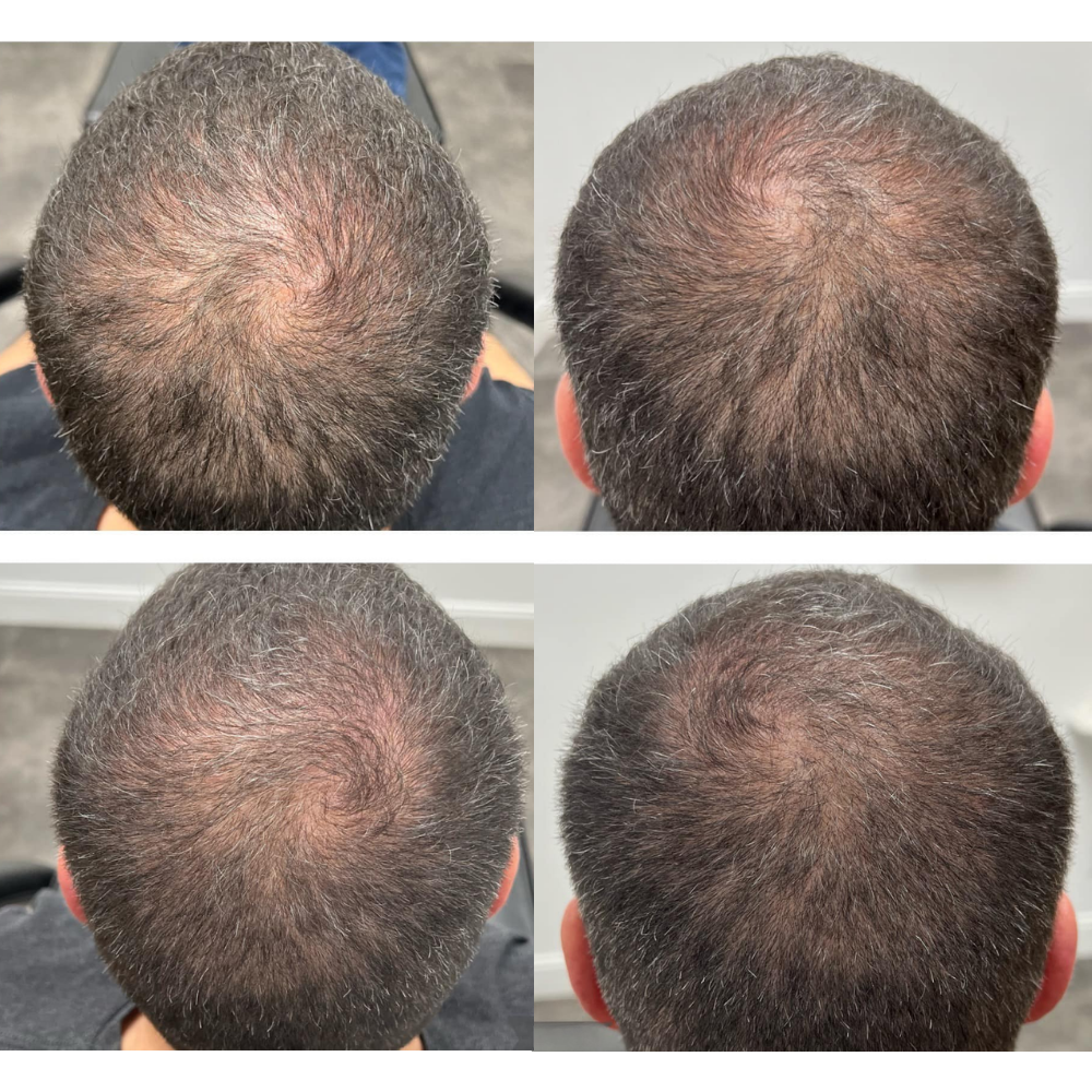 Hair rejuvenation results