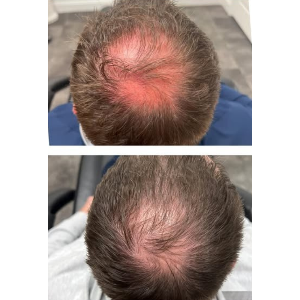 Hair restoration results by Kelly Frey
