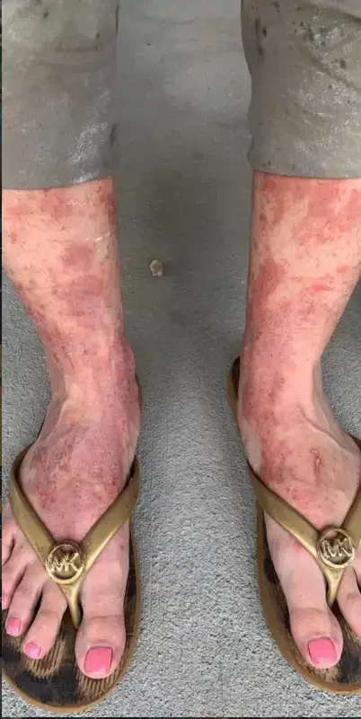 Before red light therapy