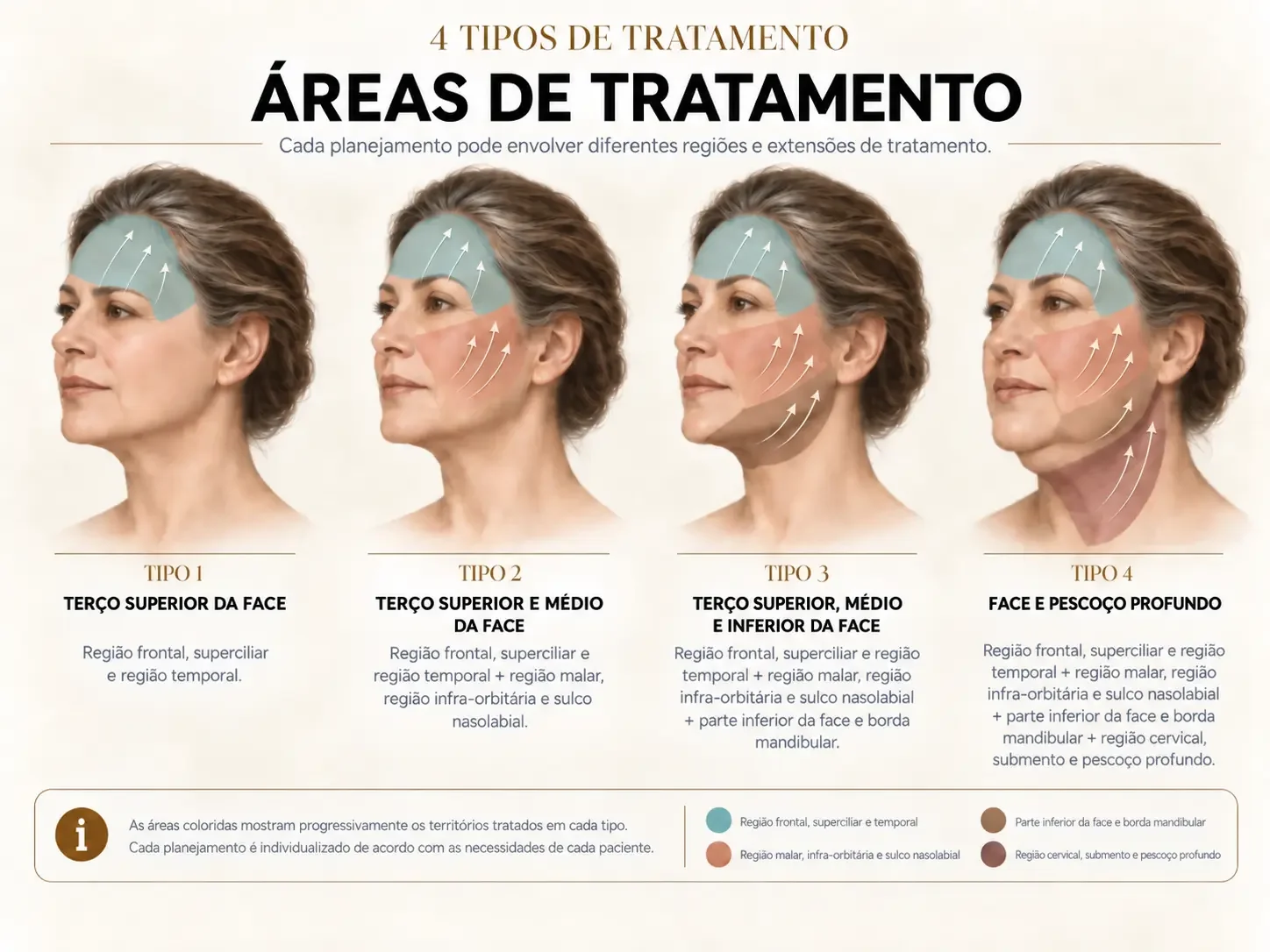 Quatro exemplos de extensão do tratamento facial, do terço superior à face e ao pescoço