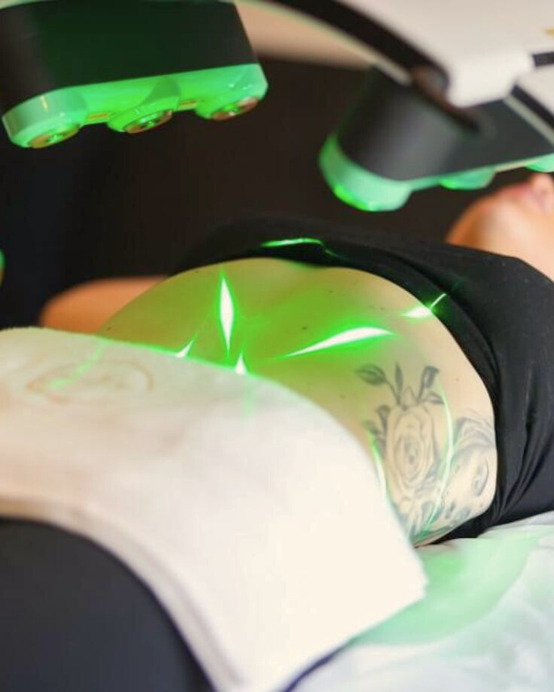 Emerald Laser treatment
