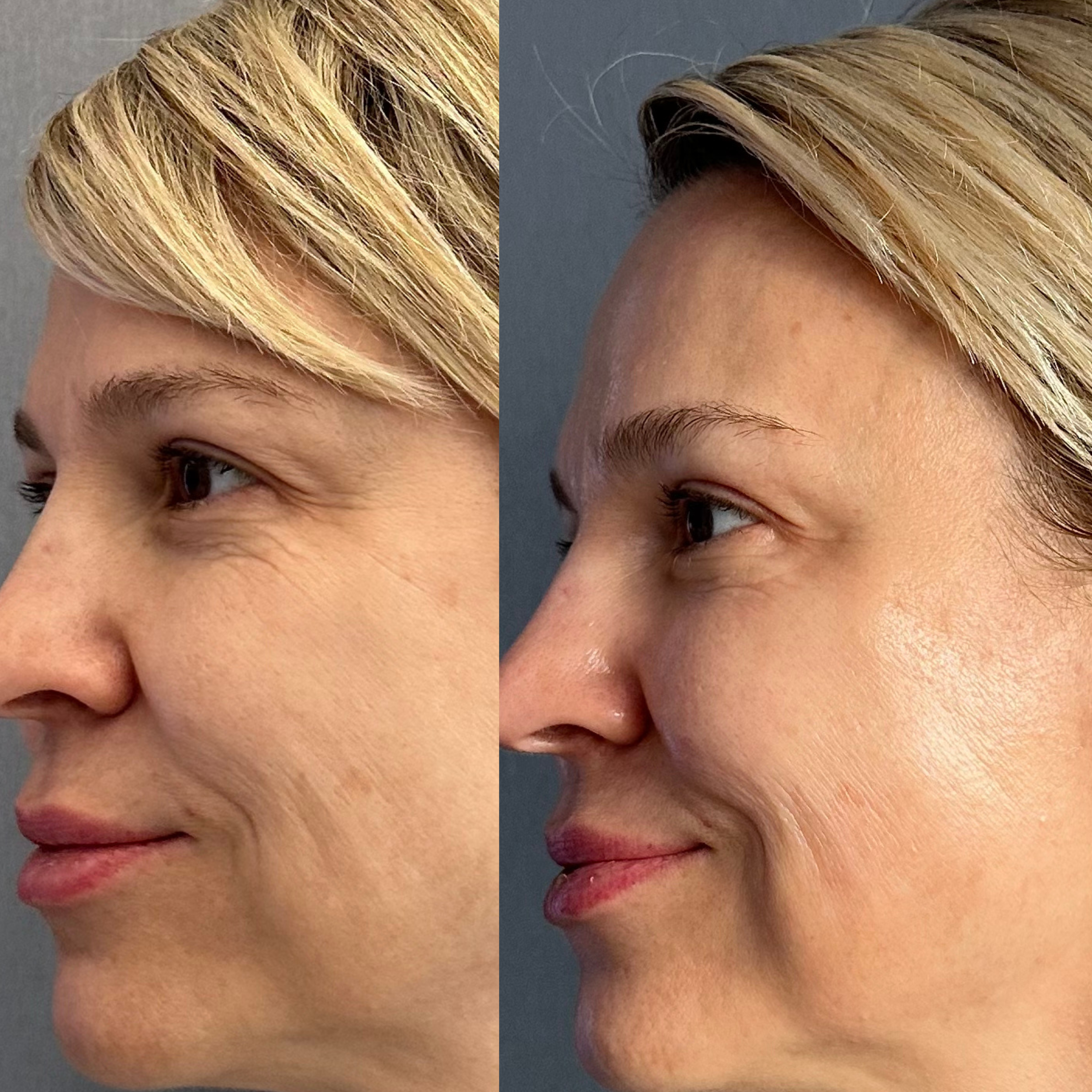Facestellar before and after — skin lifted and radiant