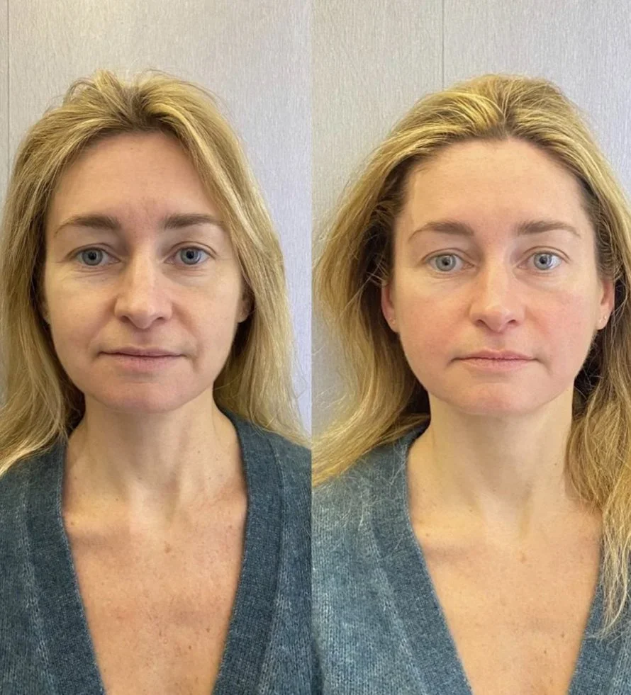 Facestellar before and after — jawline defined