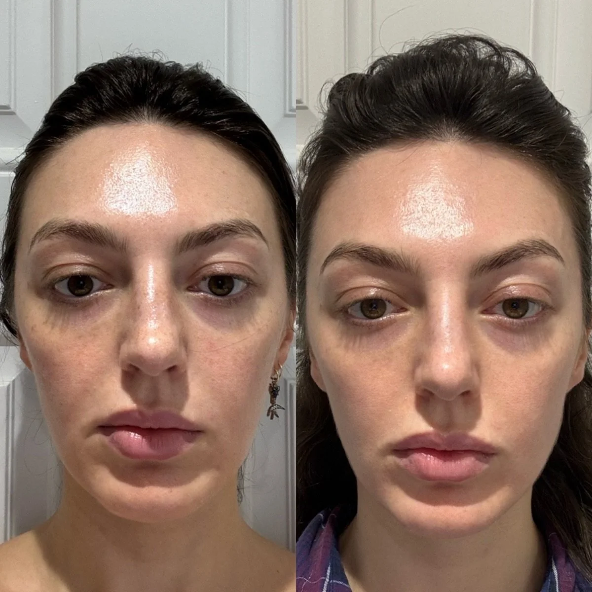 Before and after microneedling result at Facestellar Chelsea