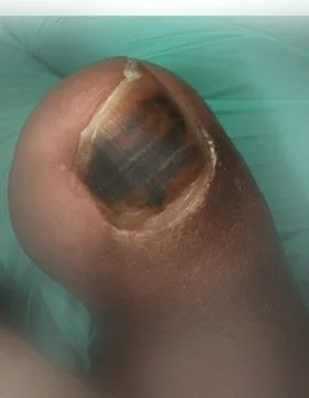 Subungual hematoma of the great toe in a patient with diabetic neuropathy: dark purple-black discoloration visible beneath an intact nail plate