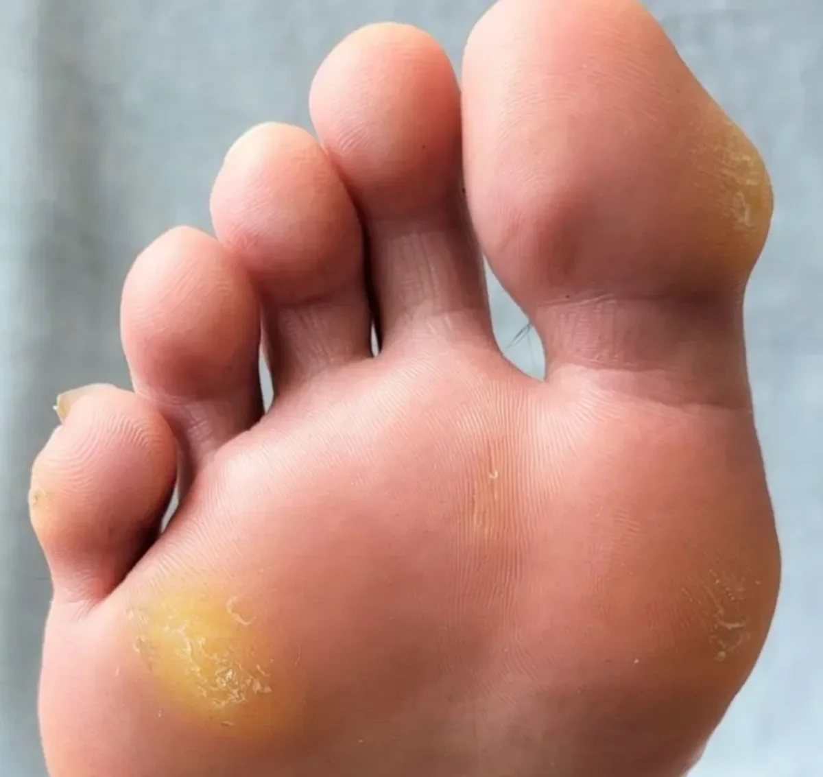 Calluses on the bottom of a foot