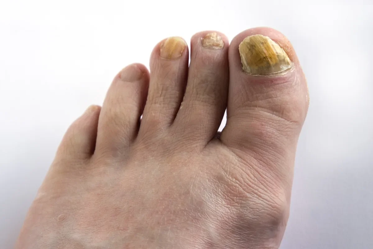 Thick fungal toenails on an older adult