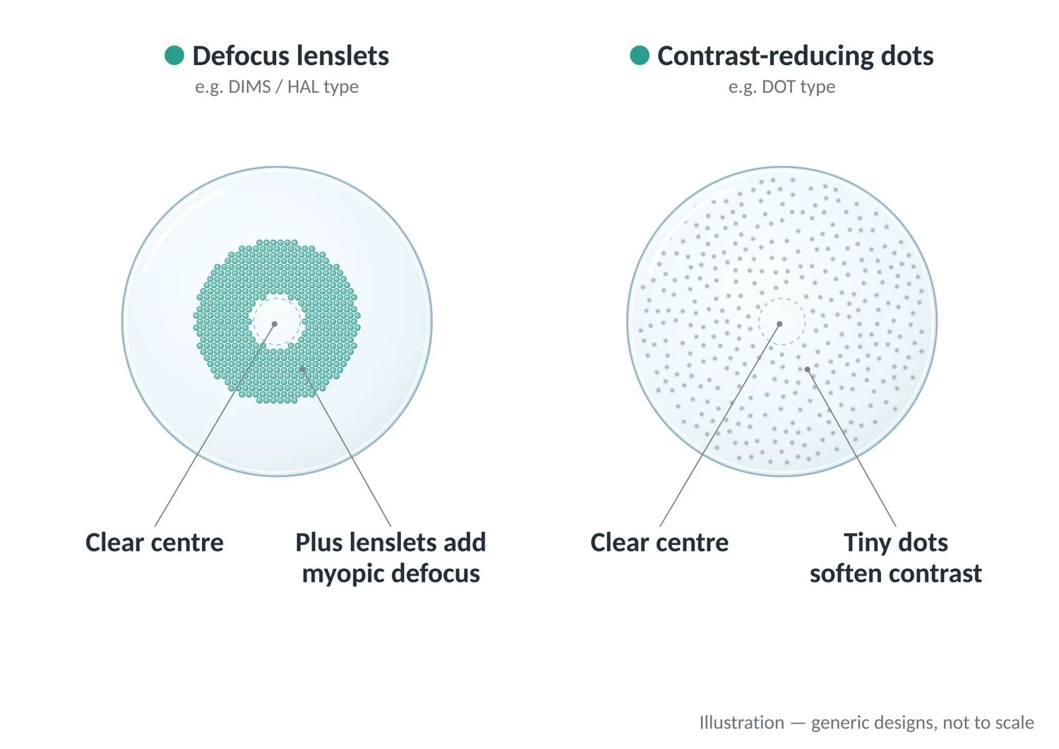 Defocus lenslet spectacle lenses have a clear centre with plus lenslets; contrast-reducing lenses use tiny dots.