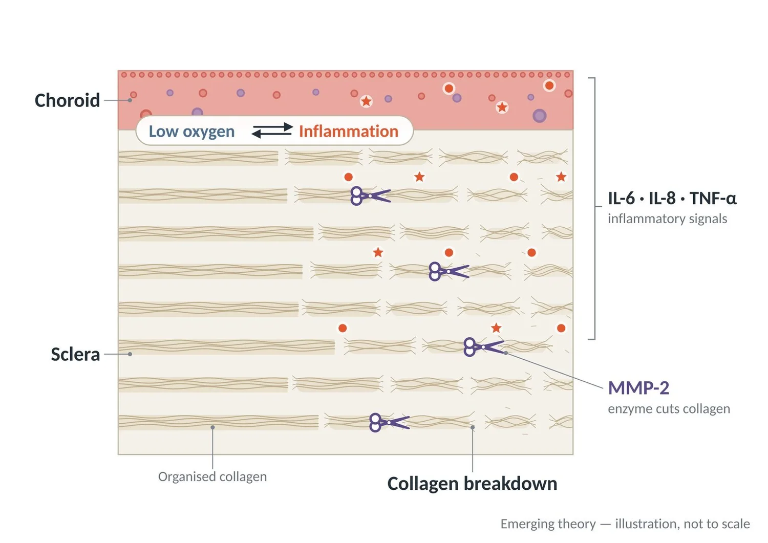 Low oxygen and inflammatory signals may activate enzymes that break down collagen in the sclera.