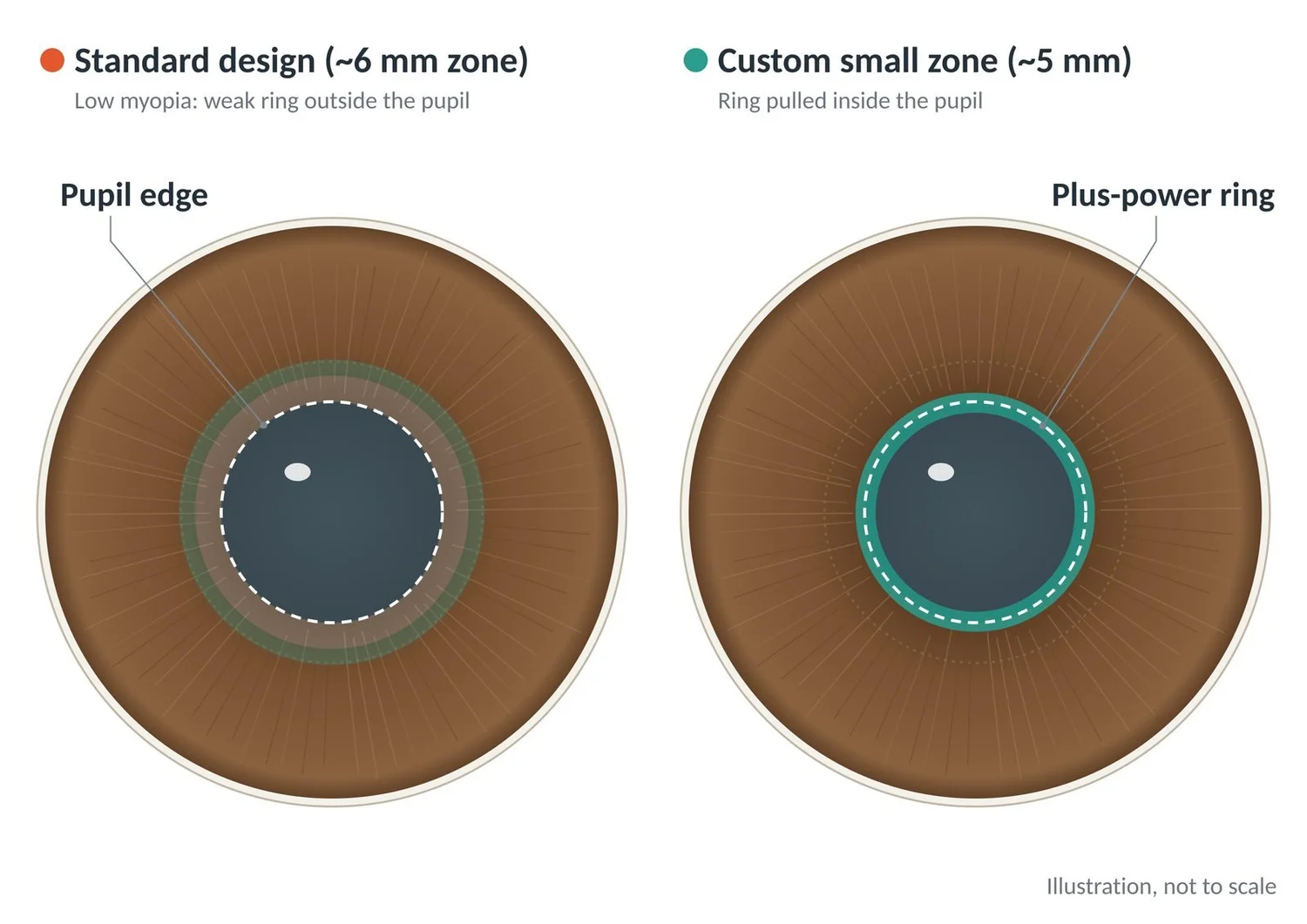 A standard design leaves the plus-power ring outside the pupil in low myopia; a custom small zone pulls it inside the pupil.