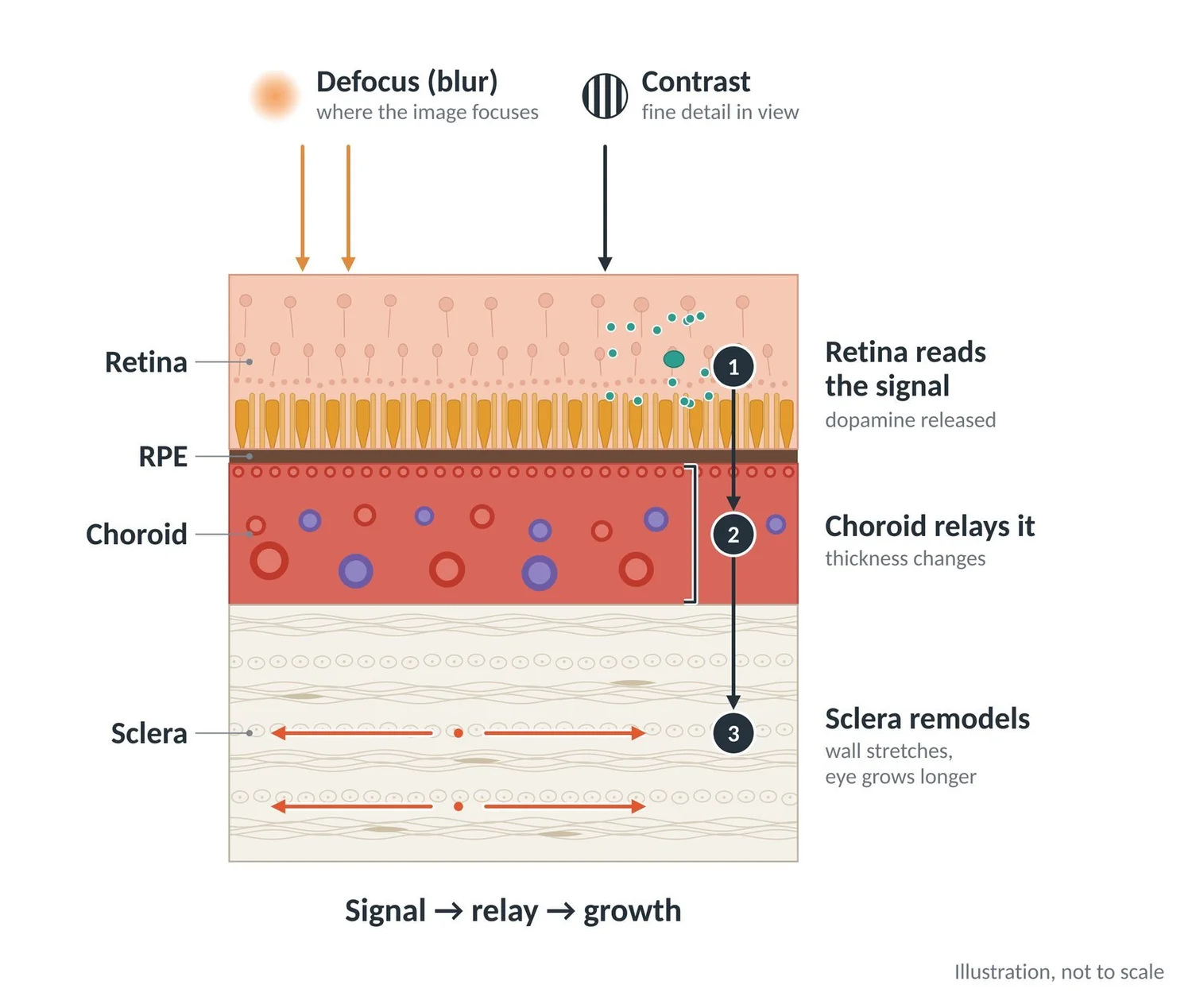 Cross-section: the retina reads blur and contrast, the choroid relays the signal, and the sclera remodels.
