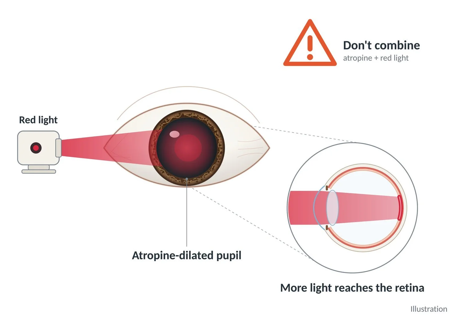 An atropine-dilated pupil lets much more red light reach the retina.