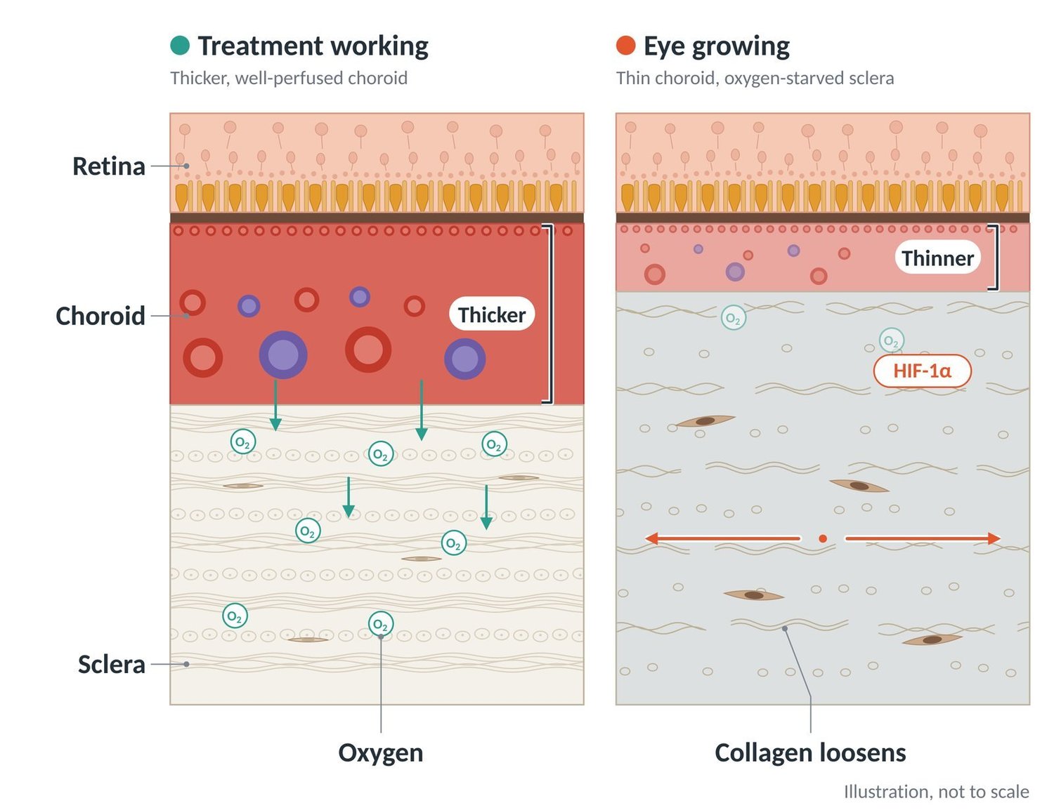 When treatment works the choroid is thicker and well perfused; in a growing eye it is thin and the sclera is starved of oxygen.