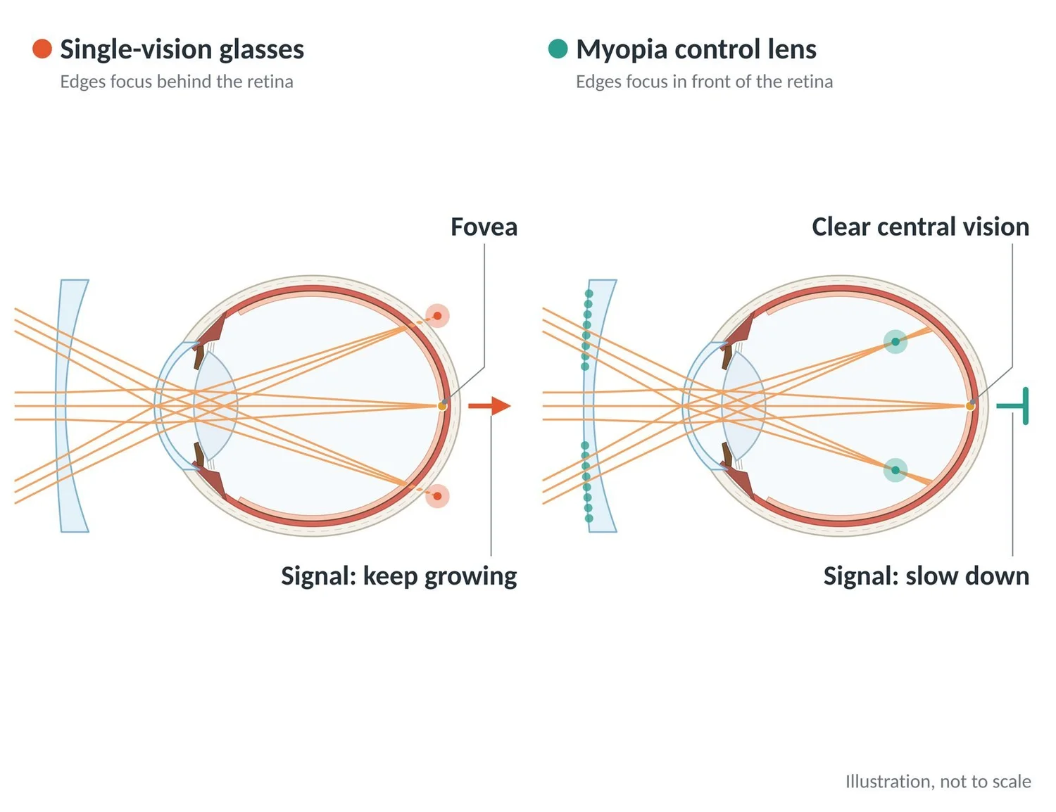 Single-vision glasses leave peripheral focus behind the retina; myopia control lenses move it in front.