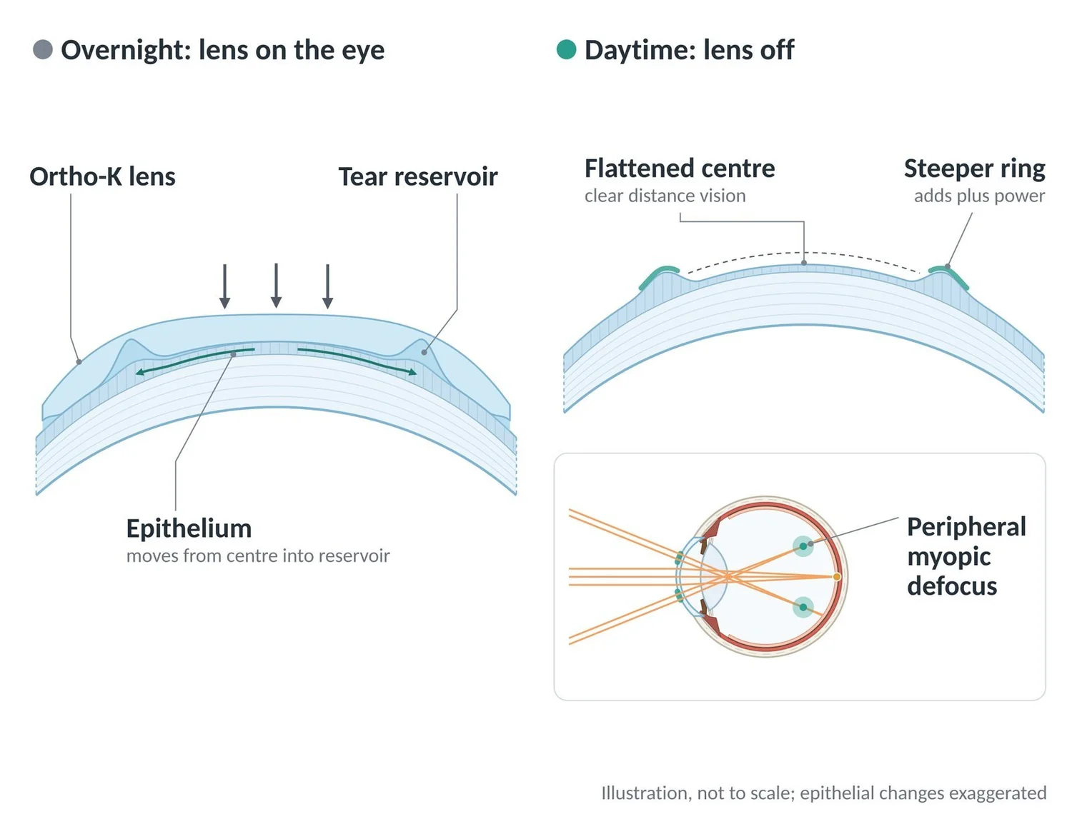 The ortho-K lens flattens the corneal centre overnight and creates a steeper ring that adds peripheral myopic defocus.