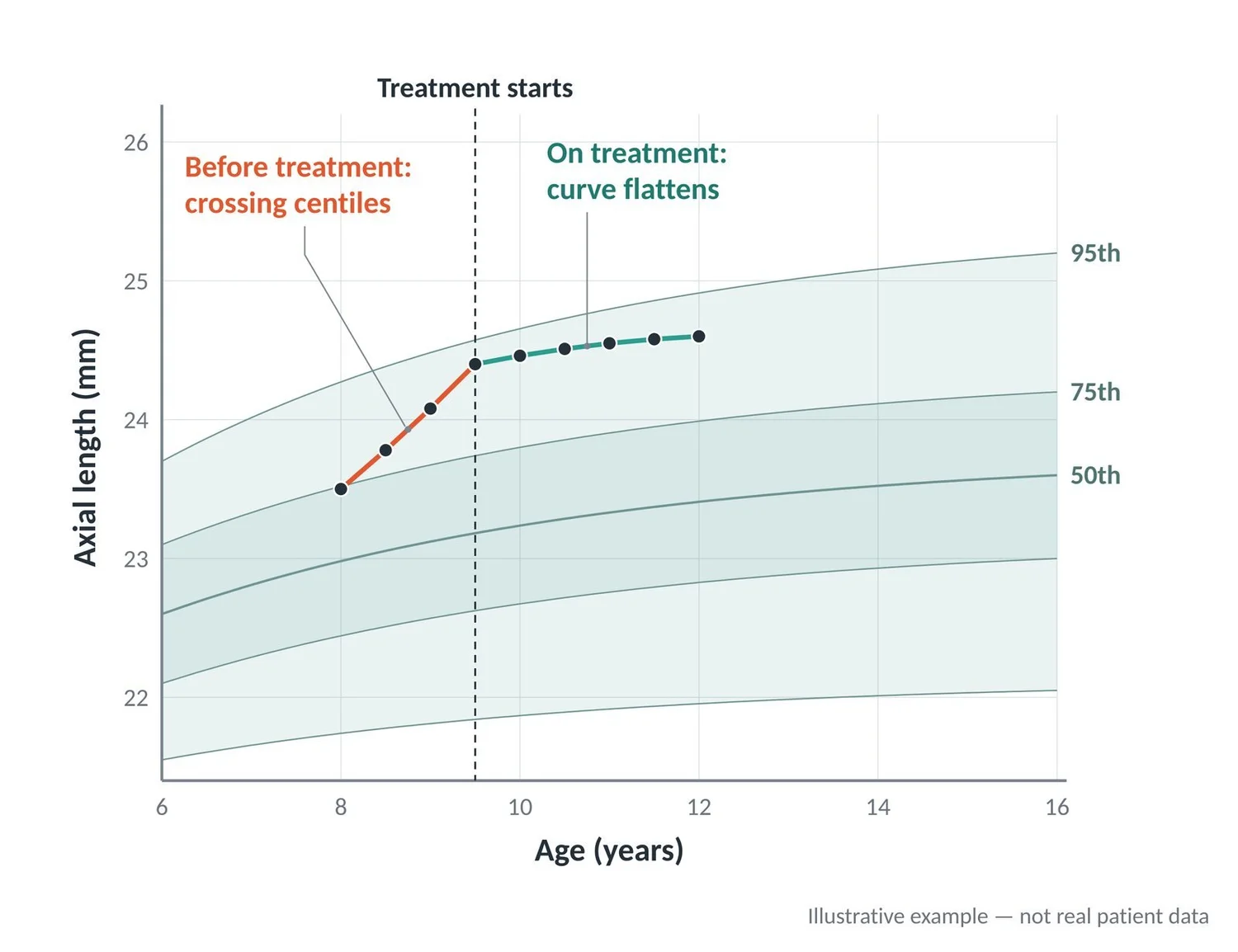 Illustrative growth chart: before treatment the eye crosses centiles; on treatment the curve flattens.