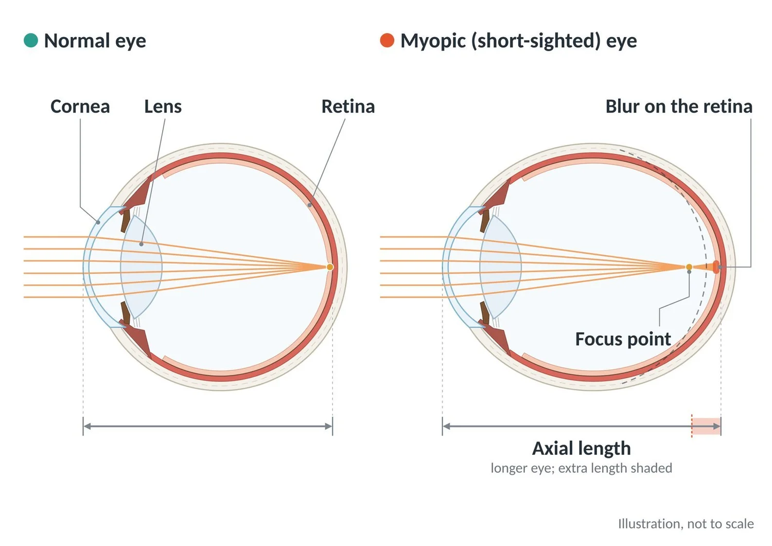 A normal eye focuses light on the retina; a longer myopic eye focuses it in front of the retina.