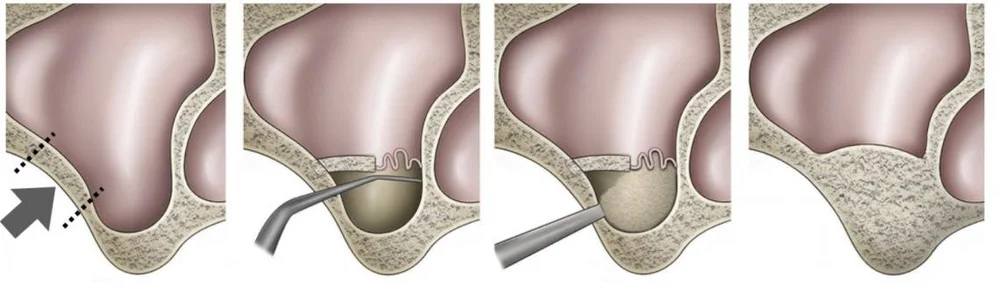 Élévation du sinus maxillaire (Sinus Lift)