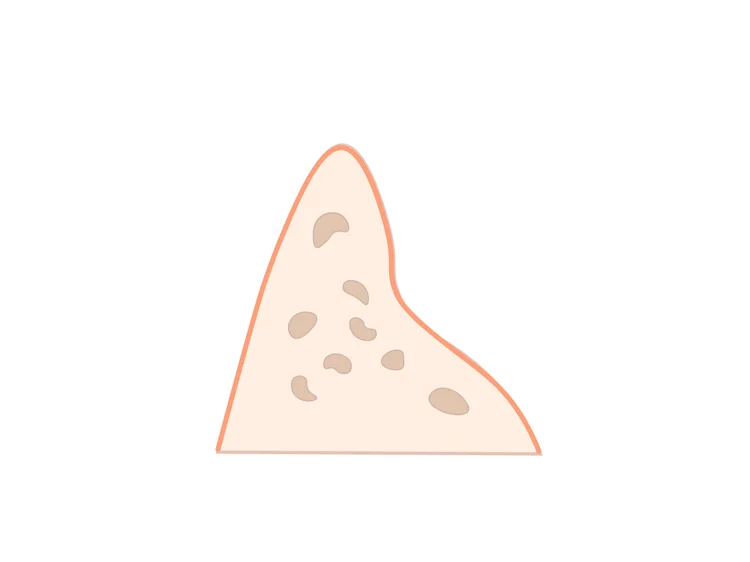 Crête osseuse résorbée