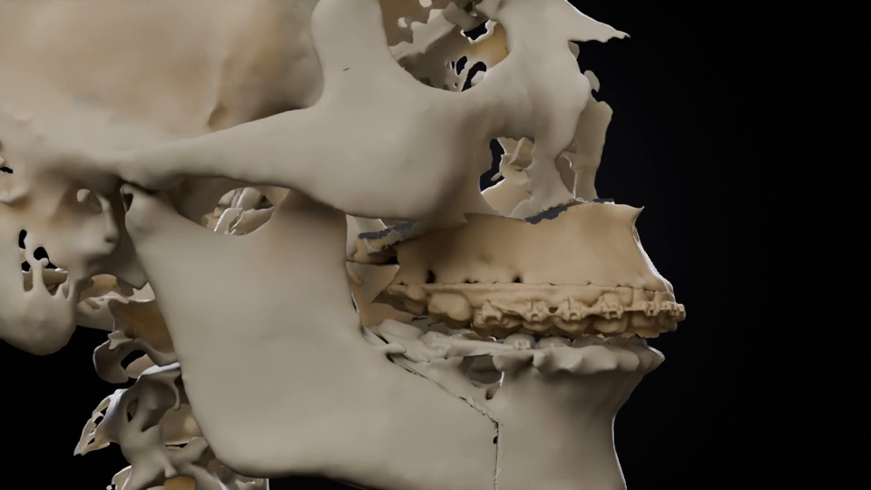 Planification d'une ostéotomie : segments osseux repositionnés sur une reconstruction 3D