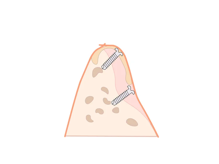 Technique des vis-tentes (Tent Screw Technique)