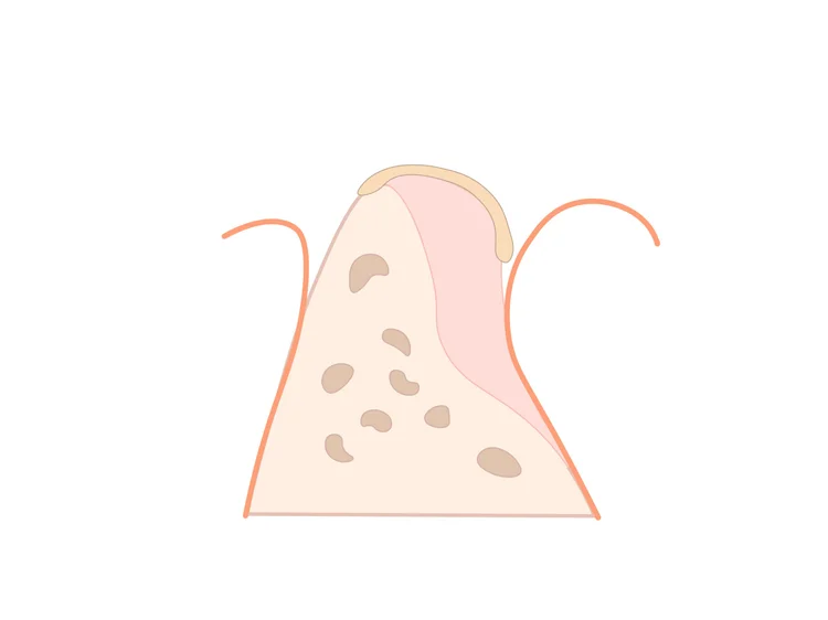 Crête reconstruite par greffe osseuse