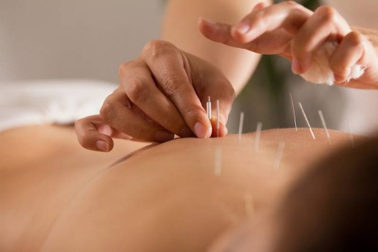 Dry needling treatment