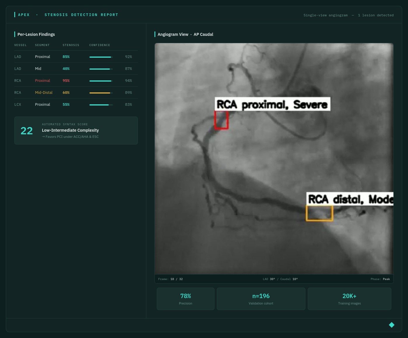 APEX Stenosis Detection Report
