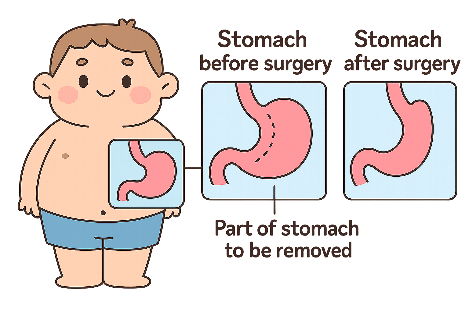 Cartoon explaining gastric sleeve