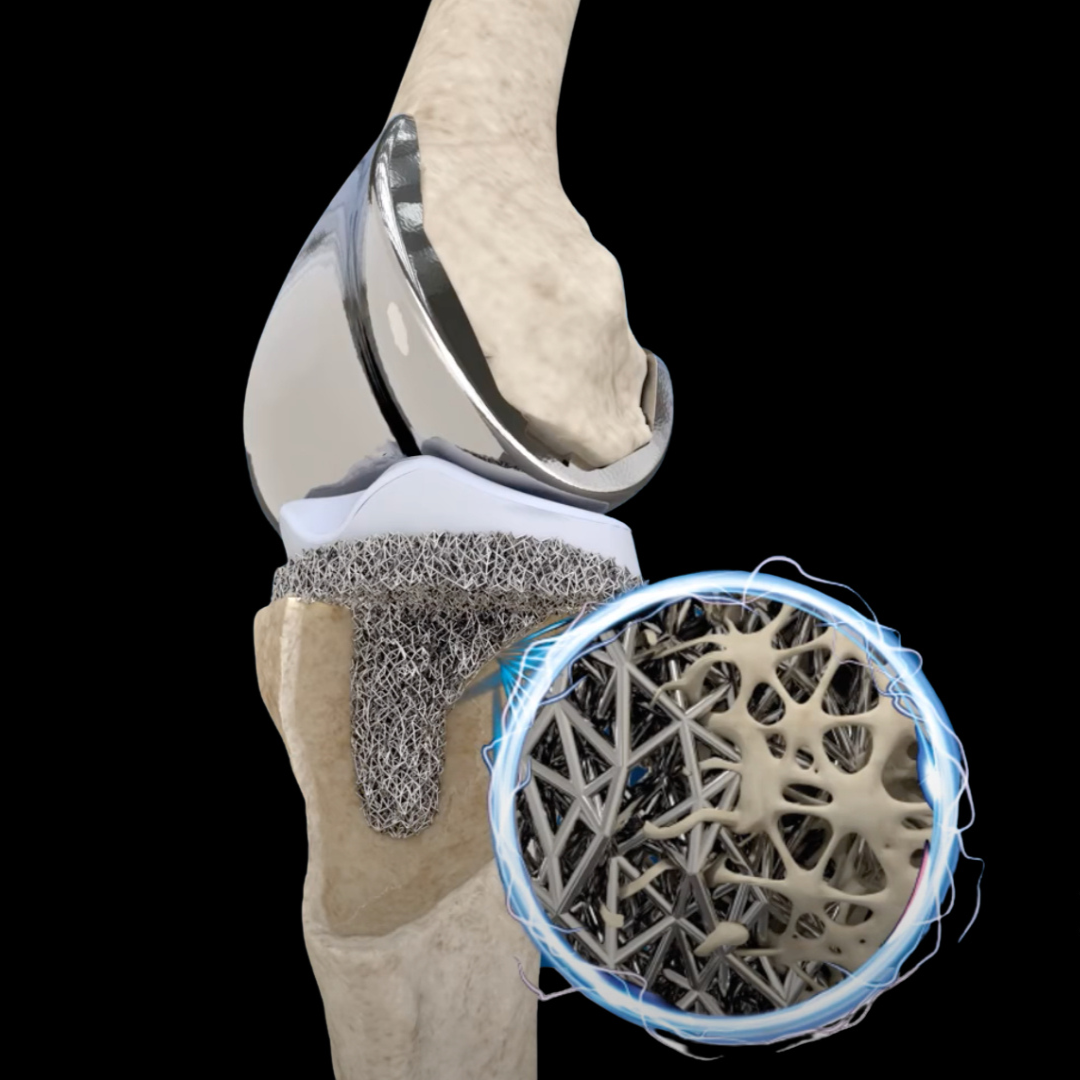 Osstec 3D printed partial knee replacement